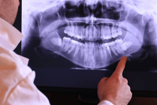 Best Knocked-Out Tooth (Avulsed Tooth) Treatment in Sun Valley, ID